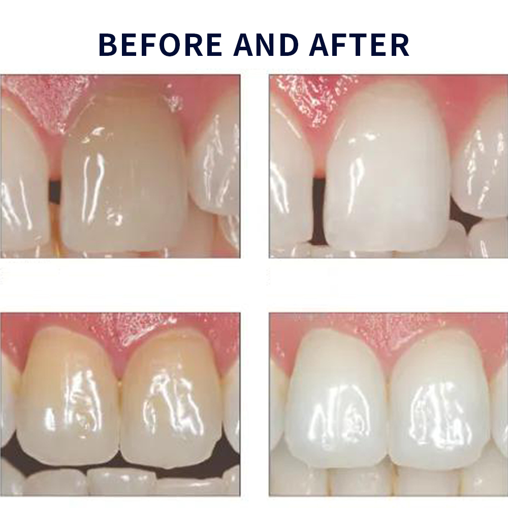 Opalescence Whitening 20% PF 2 - Teeth Whitening In Office 评论和价格
