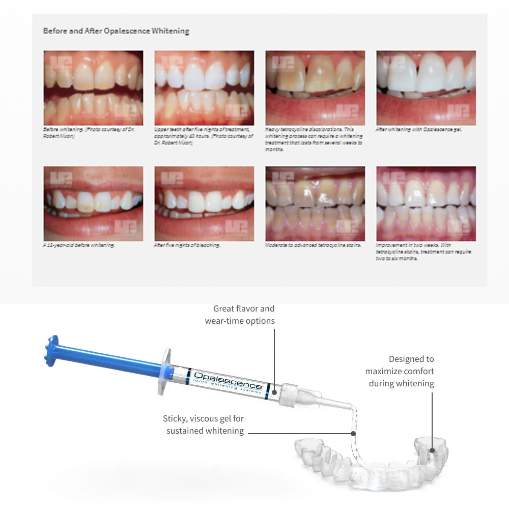 Opalescence Whitening 20% PF 2 - Teeth Whitening In Office 评论和价格