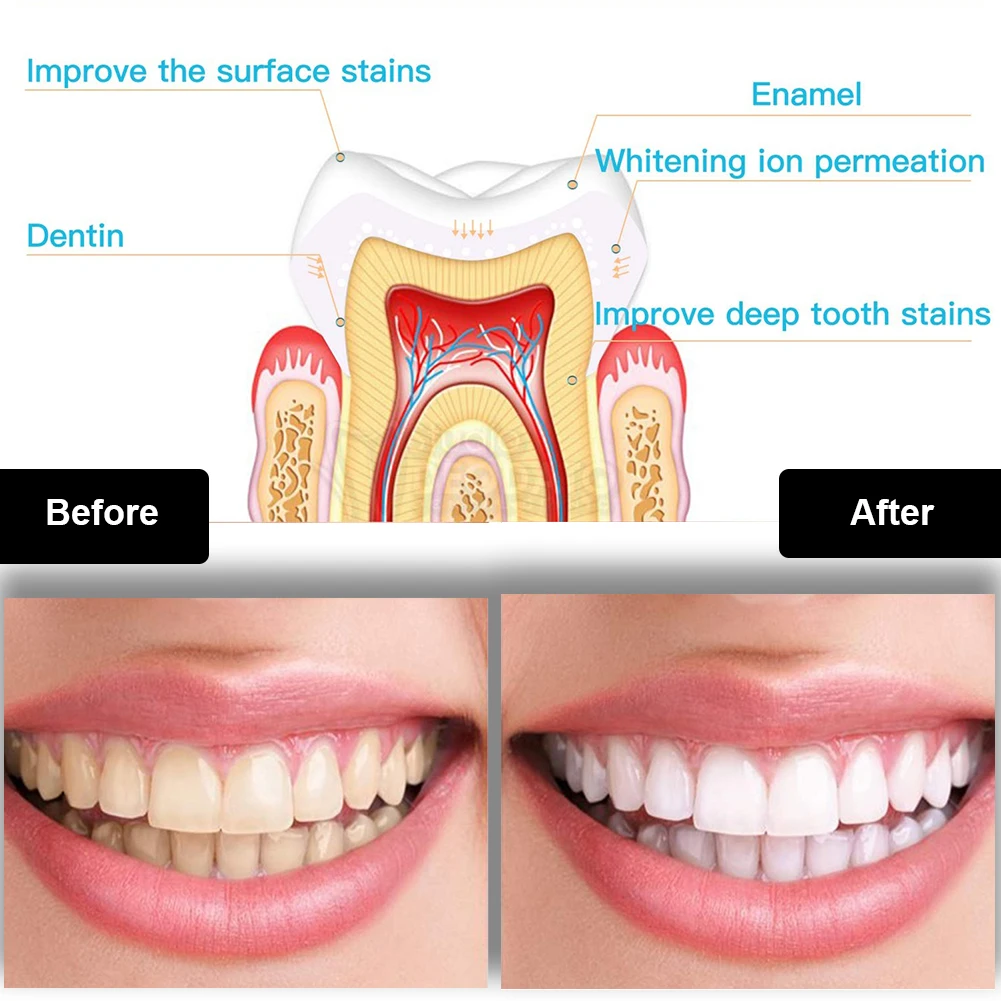 Dental Teeth Whitening Kit Min - Teeth Whitening Hismile 评论和价格